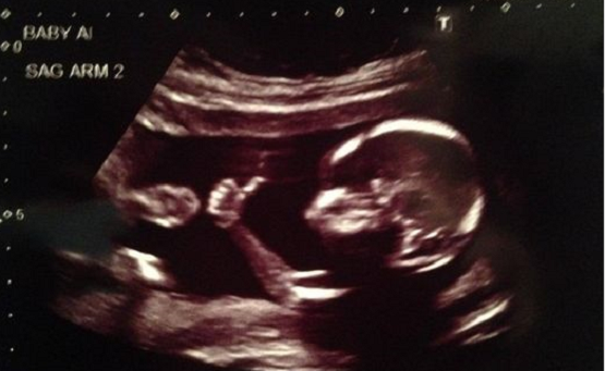 Texas Abortion Ban Saves Tens of Thousands of Babies