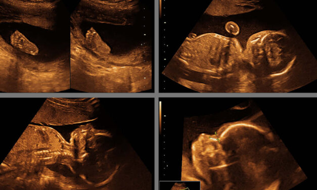 Abortion-to-birth amendments are not the solution to any of the UK’s problems