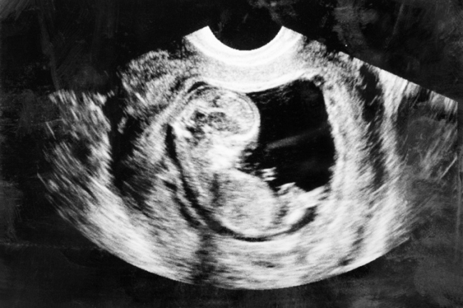 Iowa’s Pro-Life Laws Could Shut Down Planned Parenthood Centers Statewide