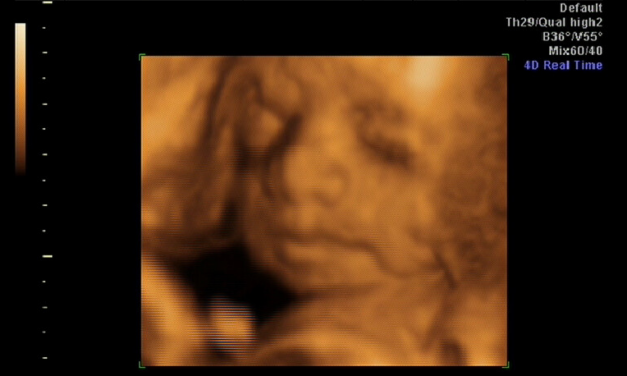 Texas and Florida Sue FDA Over Dangerous Abortion Pills