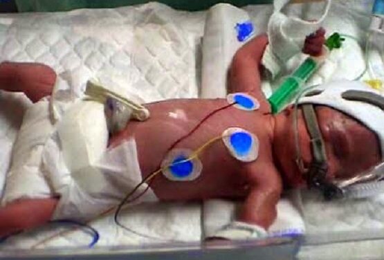 Netherlands Allows Euthanizing Newborn Babies, Canada Could be Next