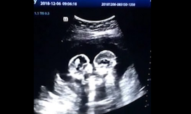 Two Babies Saved From Abortion as Grandma Helps Her Daughter Choose Life